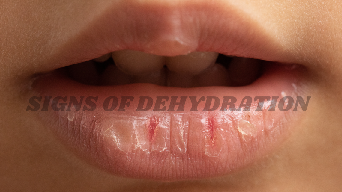 signs of dehydration