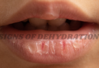 signs of dehydration