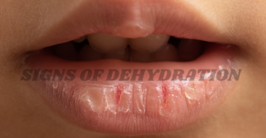 signs of dehydration
