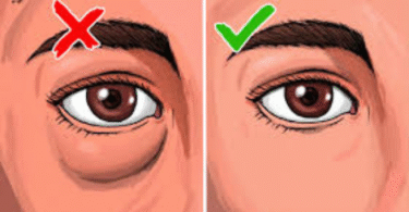 signs of kidney disease