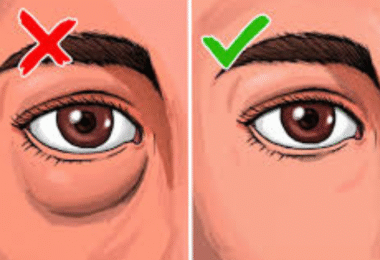 signs of kidney disease